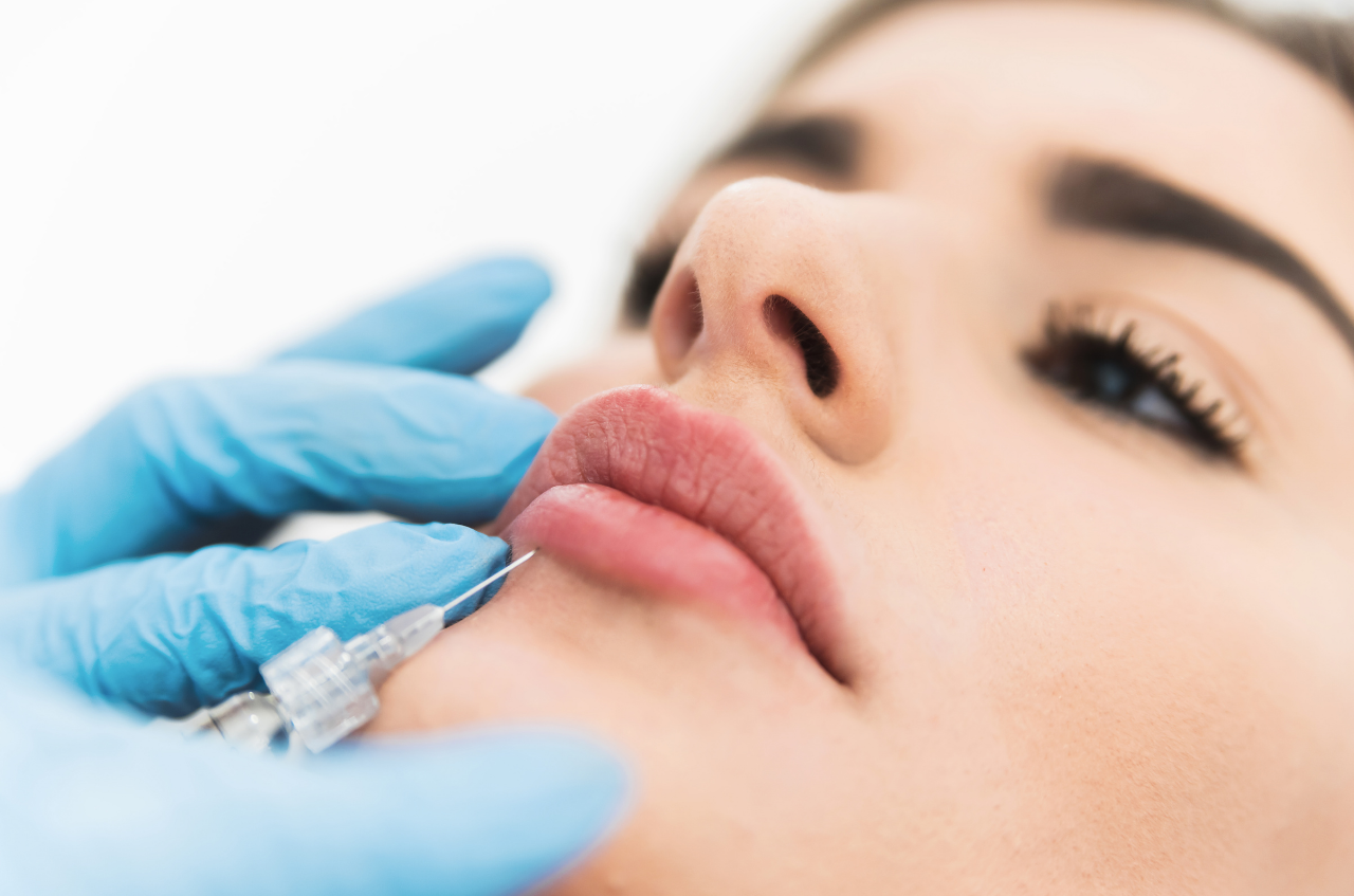 filler labbra napoli